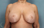 Breast Revisions Case 28 After